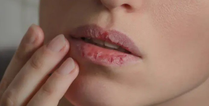 Bibir pecah-pecah.