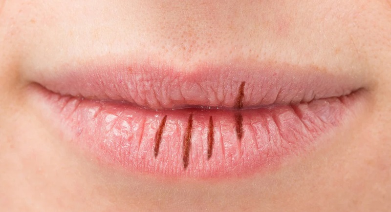 Bibir kering