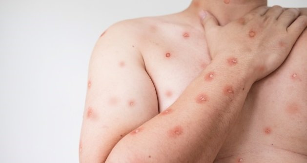 Mpox