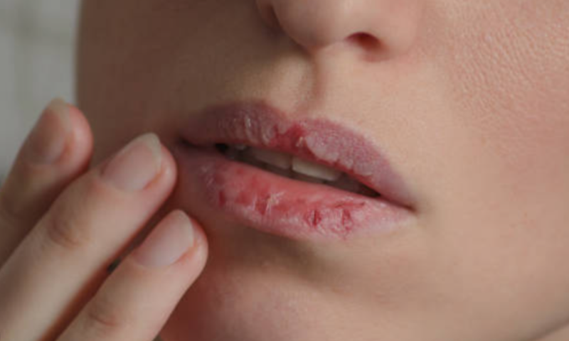 Bibir kering