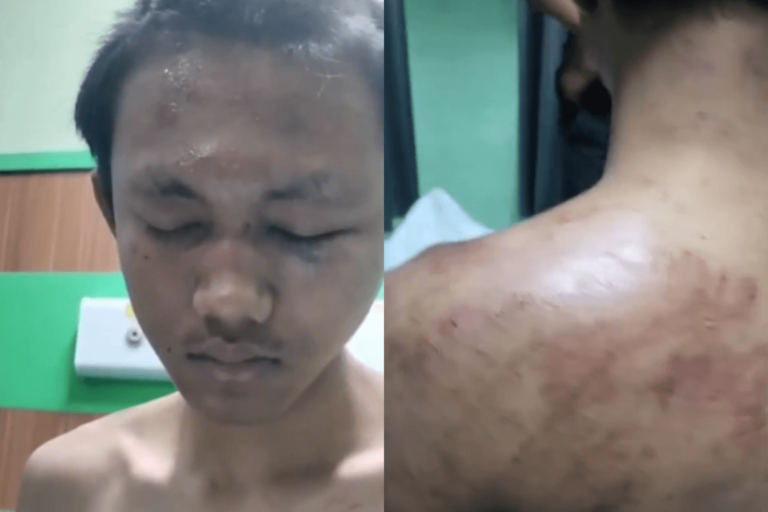 Kondisi Fisik Arendno Usai Diduga Dibully 30 Mahasiswa Undip Semarang Holopis
