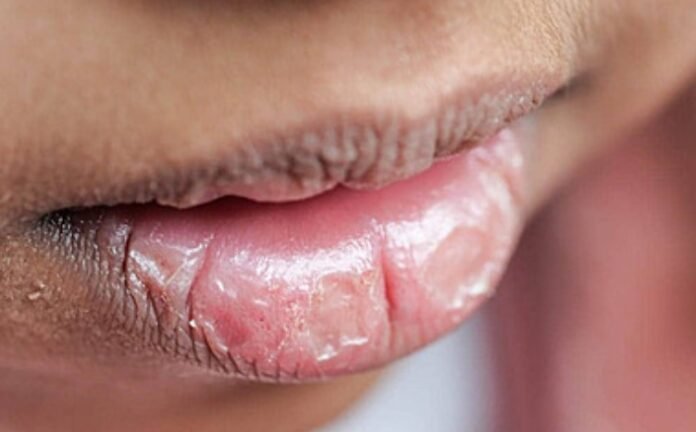 Bibir Kering Holopis.com