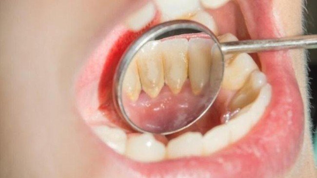Karang Gigi Numpuk?BPJS Kesehatan Bisa Bayarin, Begini Syaratnya Karang Gigi Holopis