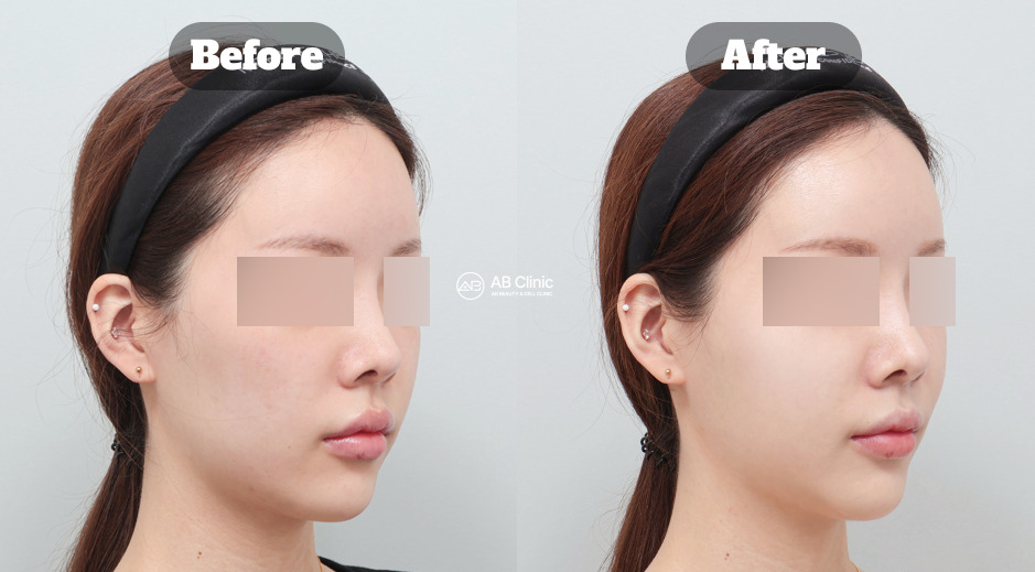 Skin Booster Korea Holopis